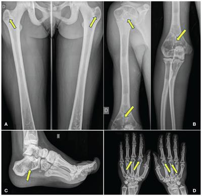 Heterogeneity and high prevalence of bone manifestations, and bone mineral density in congenital generalized lipodystrophy subtypes 1 and 2